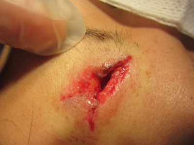 外傷治療後、8か月目。丁寧に縫合すればここまできれいな傷になります。