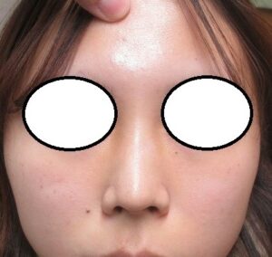 鼻筋の1センチ大のホクロの1年目の経過。