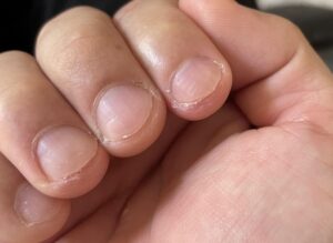 閲覧注意。高知県で5年間たらいまわしにされた難治性の手の指のイボの剥ぎ取り法。2ヶ月目の経過。