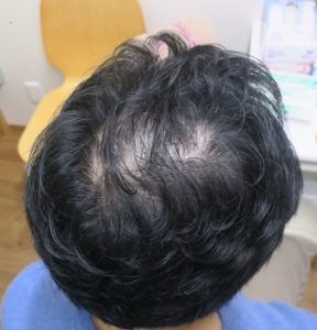 30代男性の薄毛治療。頭頂部の薄毛が1年でかなり改善しました。