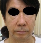 目の周りのヒアルロン酸～注入だけでここまで改善。日本製のヒアルロン酸を使用（ダイヤモンドフィール）