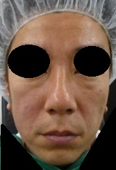 豊洲で顔全体の若返りをしましょう！美容針リフト60本2回＋肌再生FGF（目の下・ゴルゴ・ほうれい線・眉間）＋ボトックス。術後10か月目。
