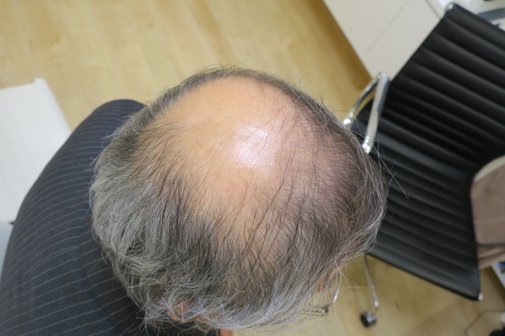 豊洲で薄毛治療！2年半で何とかここまで回復。ツルツルだった頭頂部に産毛がかなり増えてきました。