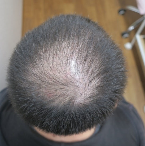 豊洲で薄毛（AGA）治療。2か月ですでに効果が出始めました。継続することが重要です。