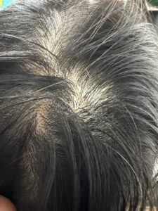 30代女性。頭皮のホクロのハゲない治療法(剥ぎ取り法）。8日目。