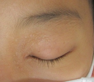 目周りの多発する稗粒腫のレーザー治療。２回目の経過。
