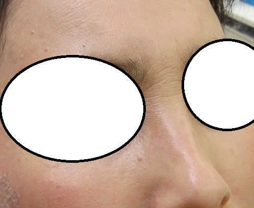 顔シミレーザー　１か月目の経過　眉間・鼻筋の大きなシミが目立たなくなりました。
