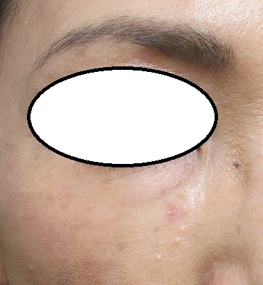 右下眼瞼の近傍のホクロ切除＋左頬の粉瘤切除。3週間目の経過。動画あり。