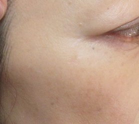 目尻・後頚部・鼻下のホクロの治療。9か月目の経過。