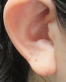 ピアスで耳たぶが裂けてしまった方の耳垂形成術。１カ月目の経過。
