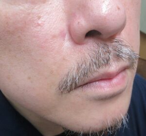 右小鼻の横の9ミリ大のホクロの切除縫合。2か月目の経過。
