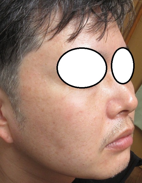 メンズの頬のシミのレーザー治療。1年目の経過。