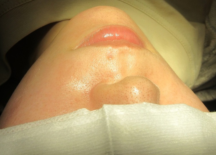 鼻の下と唇の間のかなり大きいホクロの切除（レーザー併用）。９カ月目の経過。