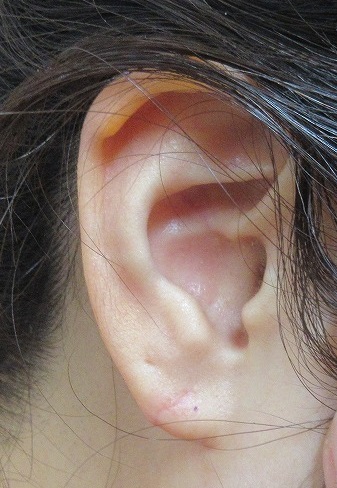 耳垂形成術（耳垂裂）の１カ月半目の経過