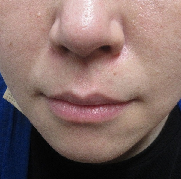 鼻下の小さいけど濃いほくろの切除。４か月目の経過