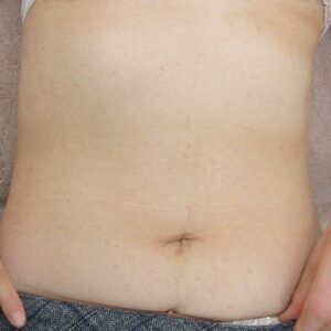 60代女性の腹部のイボレーザー取り放題治療。10ヶ月目の経過。1週目の状態もあり(かなり痛々しいです）