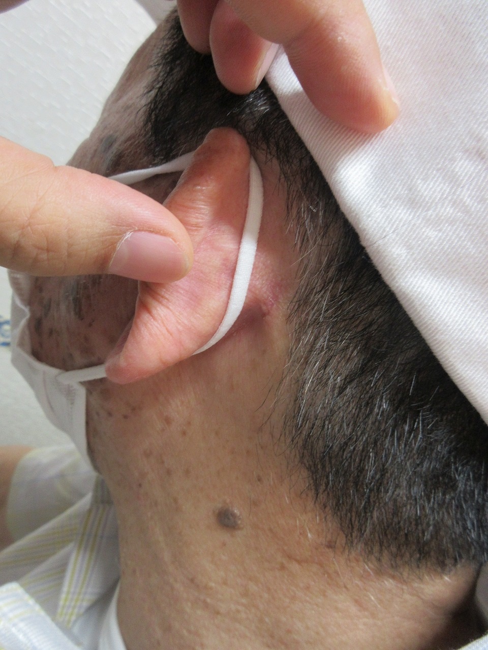 首周りの老人性のイボと頭皮内の2センチ大のイボの治療。2週目の経過。