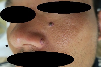 豊洲で鼻の横の大きなホクロ切除。左ホホのほくろも切除。術前・1週間目・1.5か月目。