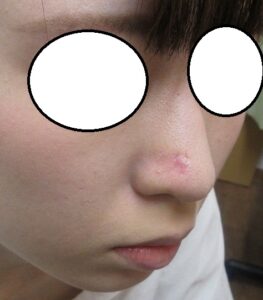 20代女性。鼻先から鼻翼にかけてのかなり大きいホクロの切除。5か月目の経過。
