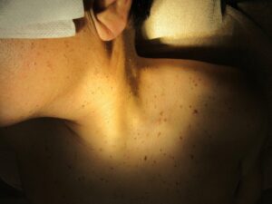 60代男性。全身の大量のイボの取り放題治療の経過。かなりきれいになりました。