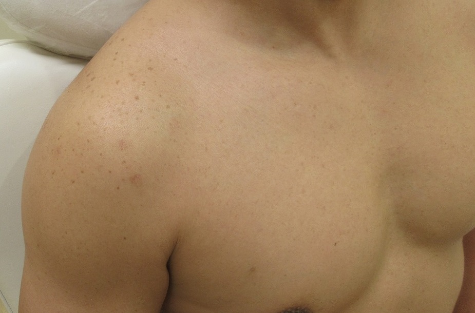 メンズの胸回りのシミレーザー治療。4カ月半目の経過。