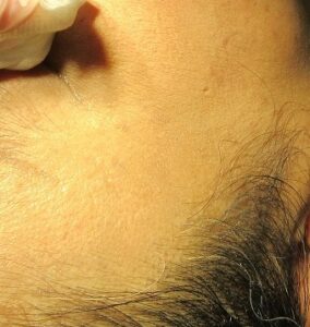 ５０代女性。顔と瞼のイボの取り放題治療、1か月目の経過。直後の写真もあり。