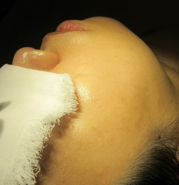 顔のイボレーザー治療。1ヶ月目の経過。