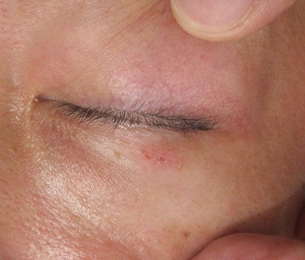 メンズの下眼瞼のまつ毛の際の目立つホクロの切除。１週目・２週目の経過。動画あり。