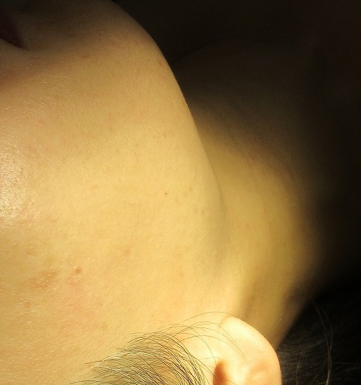 顔と首の大量のイボレーザー取り放題治療。１.５か月目の経過