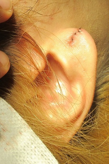 ピアスによる耳垂裂の手術。直後の状態。動画あり。