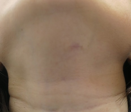首の8ミリ大の突起状のホクロを切除。2か月目。まだ赤みはありますがいい感じです。