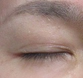 瞼のシミのレーザー治療の経過。