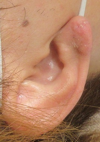 ピアスによる耳垂裂の手術。14日目の状態。動画あり。