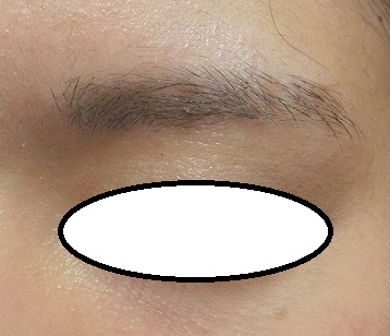 眉頭と眉尻の大きいホクロの剥ぎ取り切除＋レーザー治療。１２カ月目の経過。