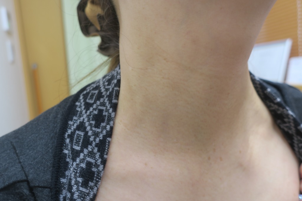 首のイボイボが2回のレーザー治療でツルツルになりました。60代女性、6か月目の経過。