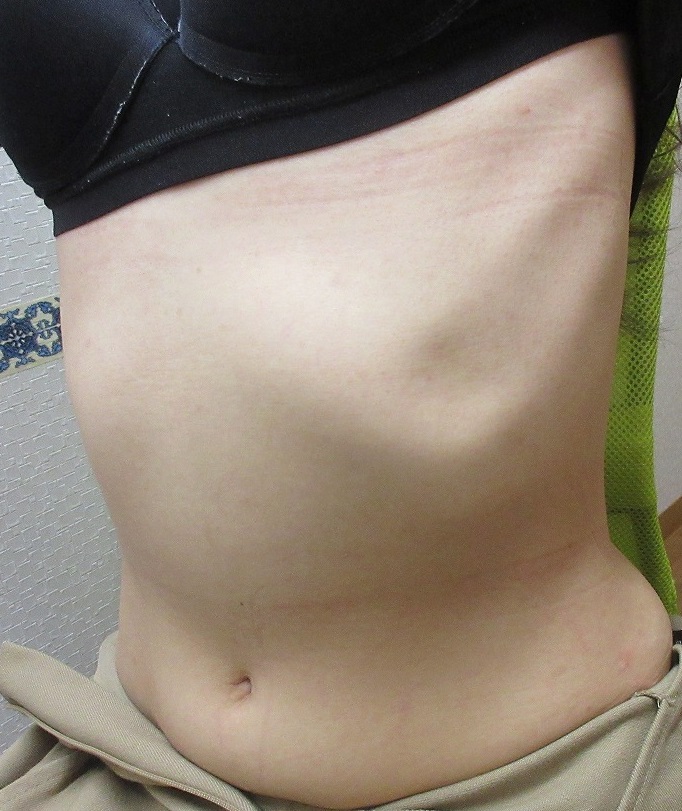 腹部周りの大量のイボのレーザー取り放題治療の様子。9か月目の経過。