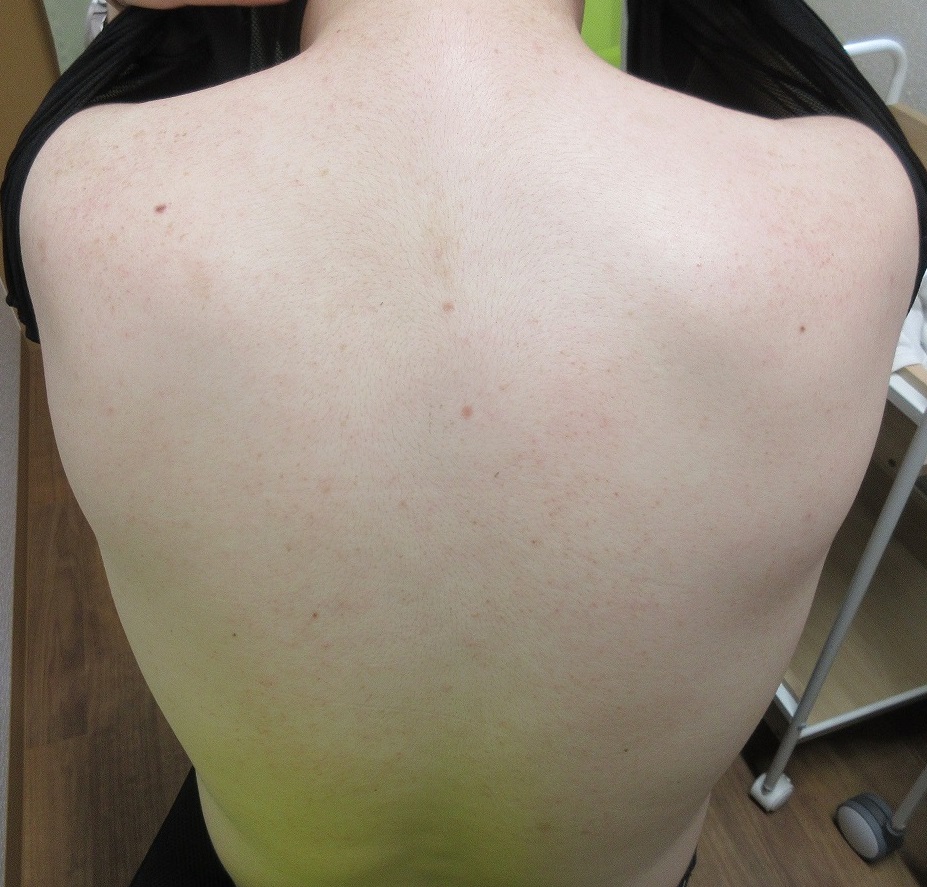 メンズの背中のシミのレーザー治療。1ヶ月目の経過。