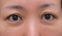 目の下のクマの手術1年4か月目＋瞼のたるみ切除（眉下切開法）1週間目。