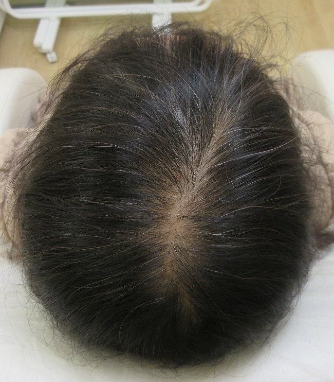 豊洲で女性の薄毛治療。AGF39によるメソセラピー。６回目の経過。