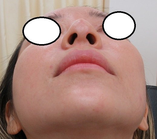 糸による鼻の形成。2年目の経過。今回はクレオパトラノーズ８本で鼻尖をさらに細くしました。直後の状態。