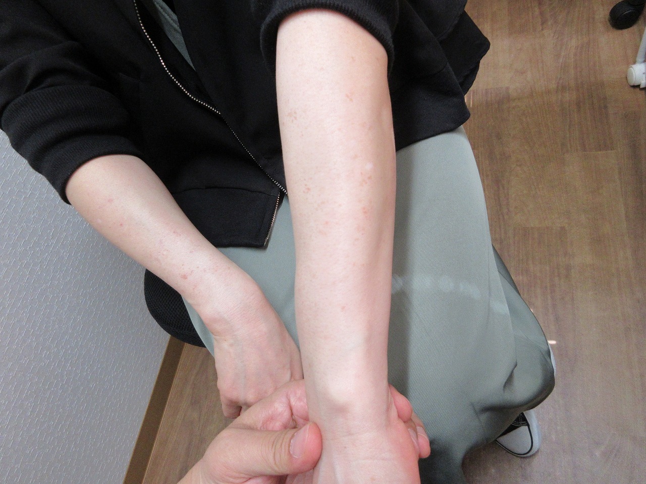 腕のシミのレーザー治療。5か月目の経過。