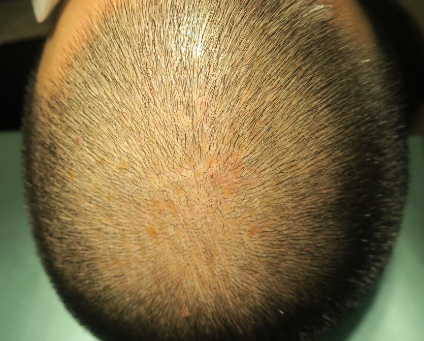 頭皮の老人性のイボをレーザー治療。かなりきれいになりましたね。２か月目の経過。