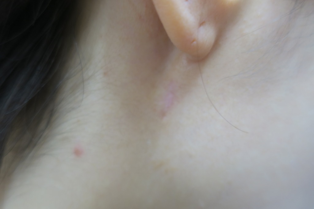 首筋～耳下の大きなホクロを切除。4か月目の経過。かなりきれいになりました。