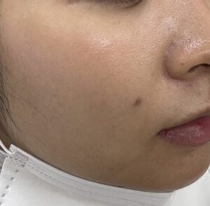 30代女性。顔のホクロをレーザー治療でトライ。2ヶ月目の経過。