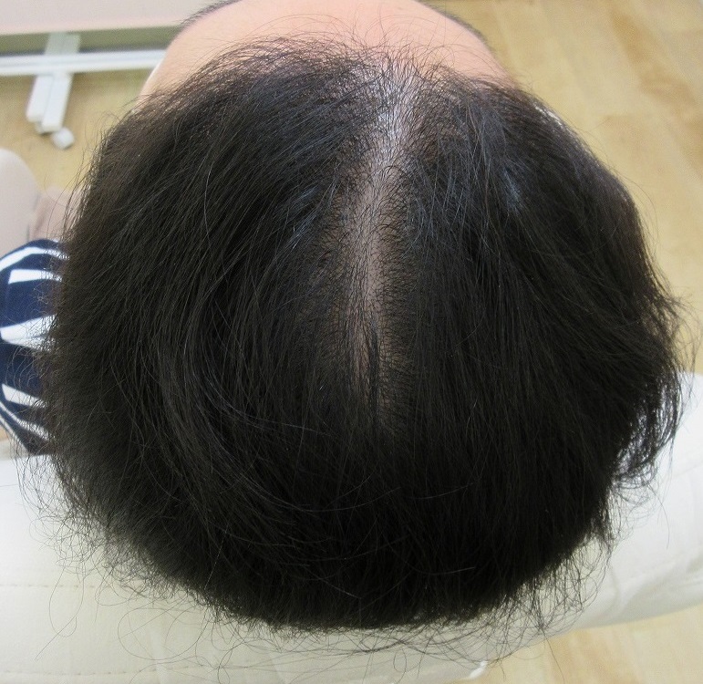 女性の薄毛治療。メソセラピー８回終了時点でここまで改善。もう一息。