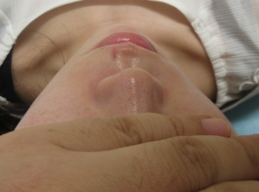 鼻の下（一部口唇にかかる）の1センチ大のホクロの切除。9日目の経過。