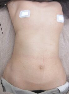 40代女性。胸腹のイボのレーザー取り放題治療。4カ月半目の経過。