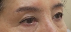 眉下切開法による上眼瞼の若返り術。8か月目の経過。自然な二重になりました。