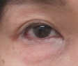 右下眼瞼のまつ毛の生え際のホクロの切除。直後の状態。