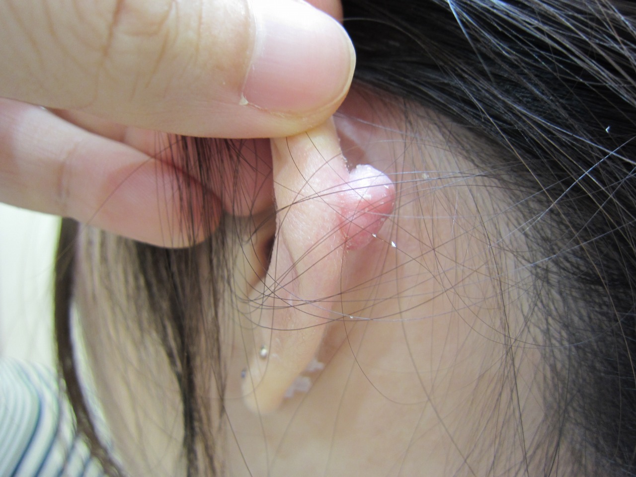 耳ピアスのトラブル。1センチ以上の大きさのケロイドを切除＋皮弁形成。術後1年経過。